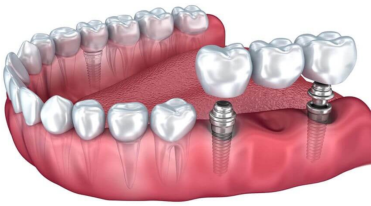 Informatii Pe Care Trebuie Le Stii Despre Implantul Dentar